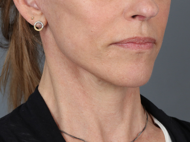 Neck Lift Before and After | Dr. Michael Kim