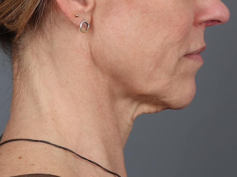 Neck Lift Before and After | Dr. Michael Kim