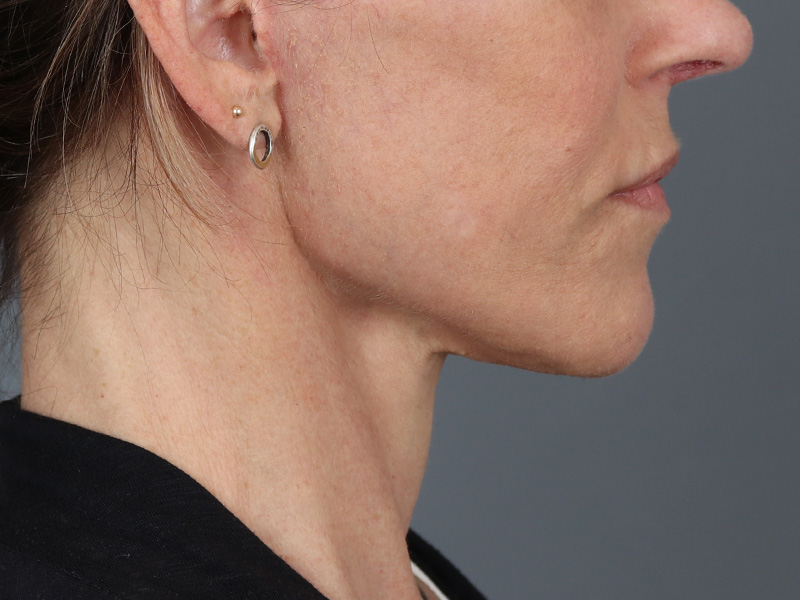 Neck Lift Before and After | Dr. Michael Kim
