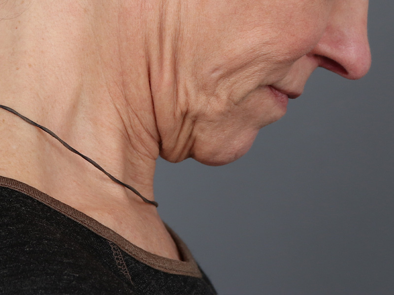 Neck Lift Before and After | Dr. Michael Kim
