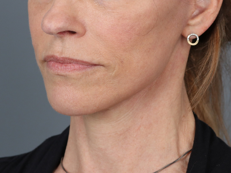 Neck Lift Before and After | Dr. Michael Kim