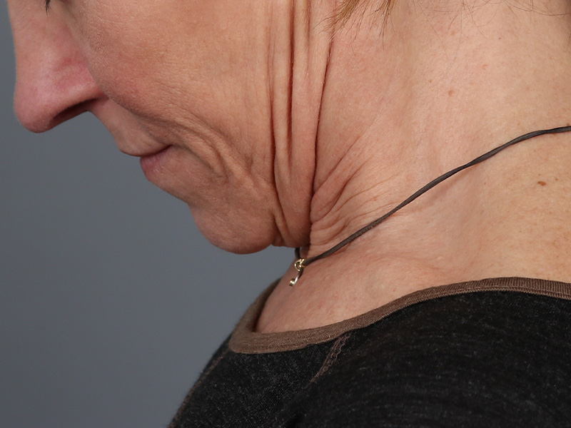 Neck Lift Before and After | Dr. Michael Kim