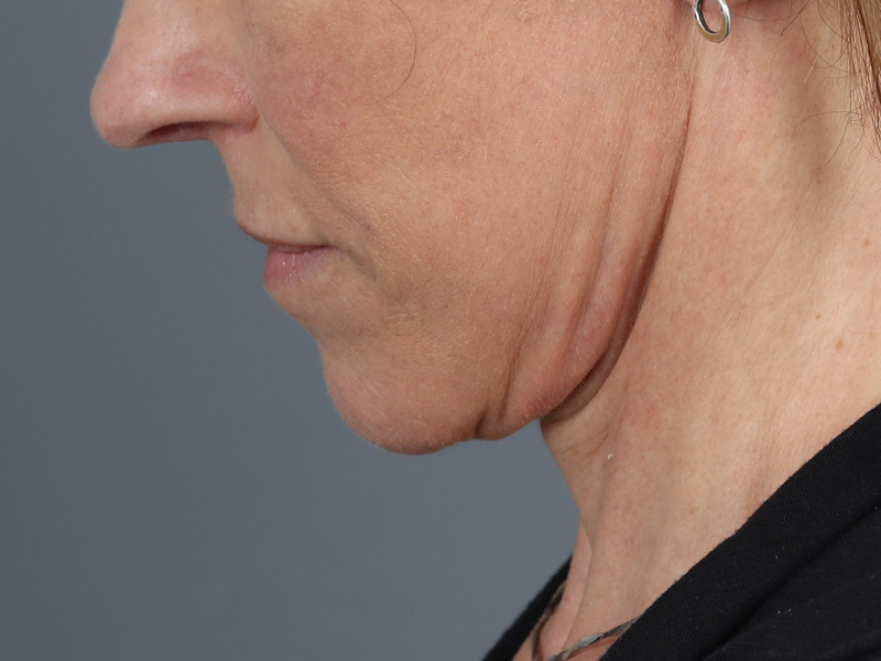 Neck Lift Before and After | Dr. Michael Kim