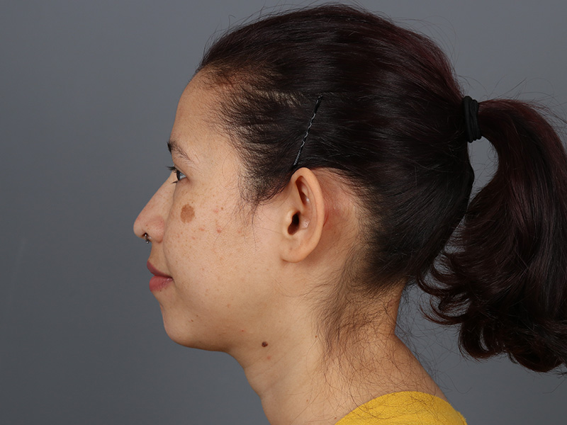 Otoplasty Before and After | Dr. Michael Kim