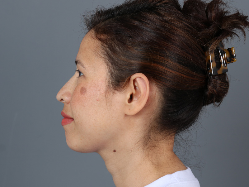 Otoplasty Before and After | Dr. Michael Kim