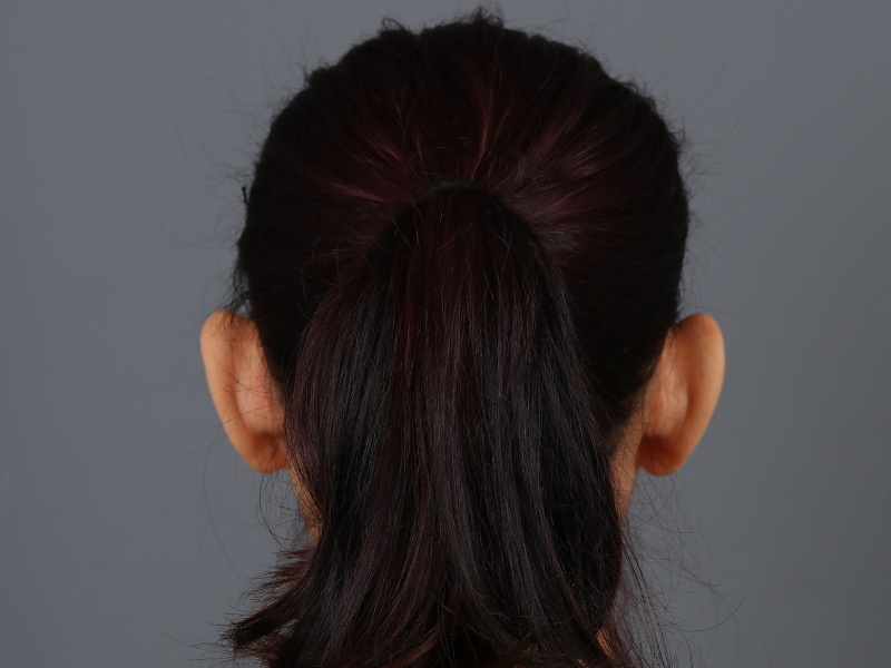 Otoplasty Before and After | Dr. Michael Kim