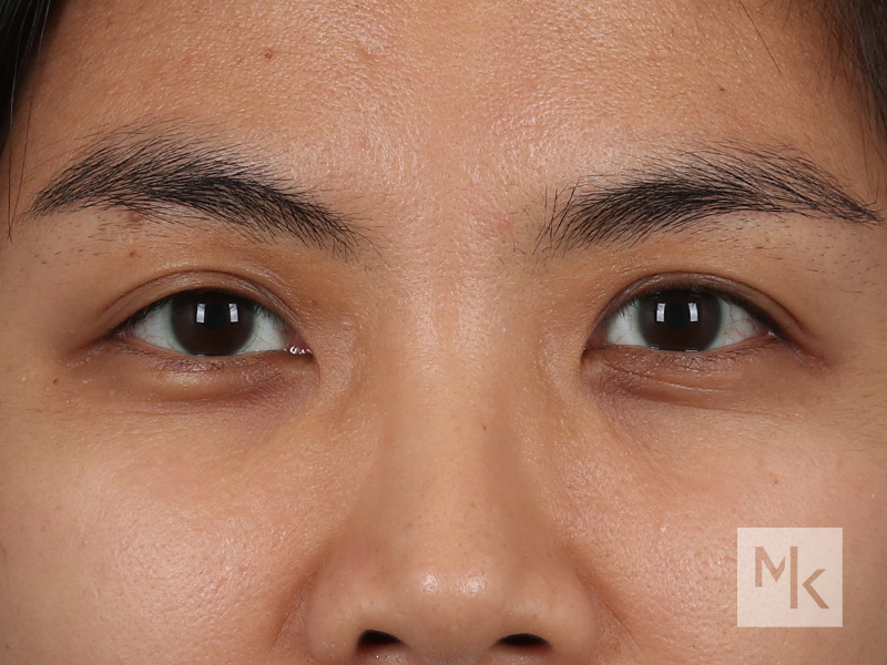 Periorbital Filler Before and After | Dr. Michael Kim