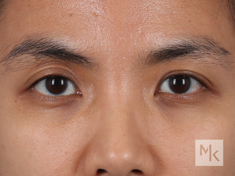 Periorbital Filler Before and After | Dr. Michael Kim