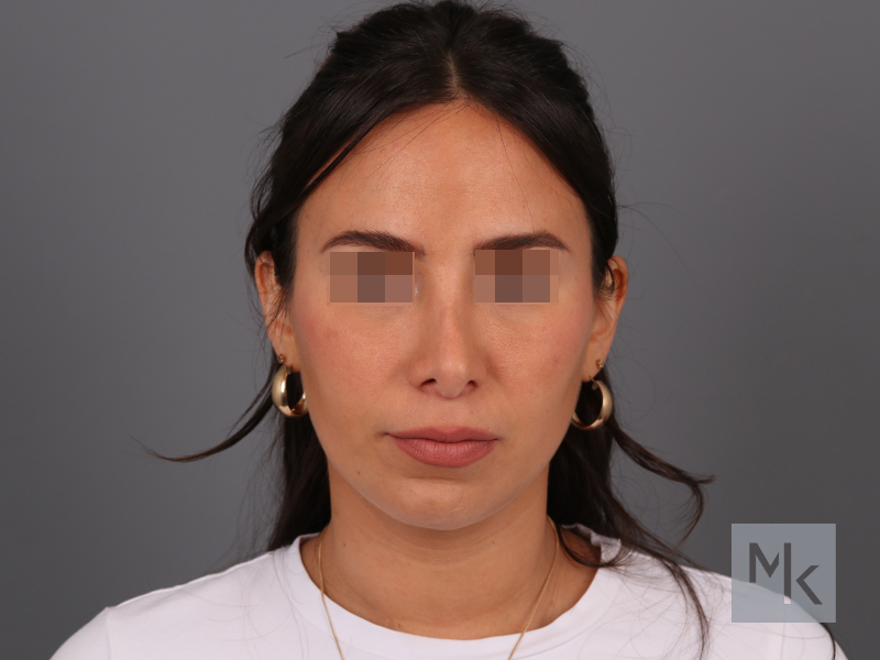 Rhinoplasty Revision Before and After | Dr. Michael Kim