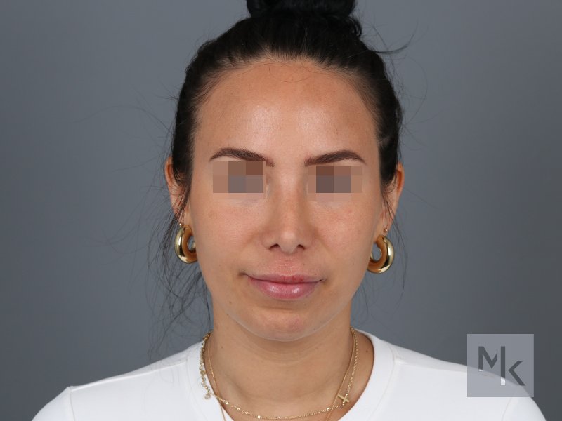 Rhinoplasty Revision Before and After | Dr. Michael Kim