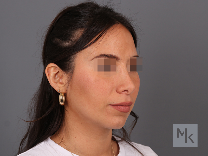 Rhinoplasty Revision Before and After | Dr. Michael Kim