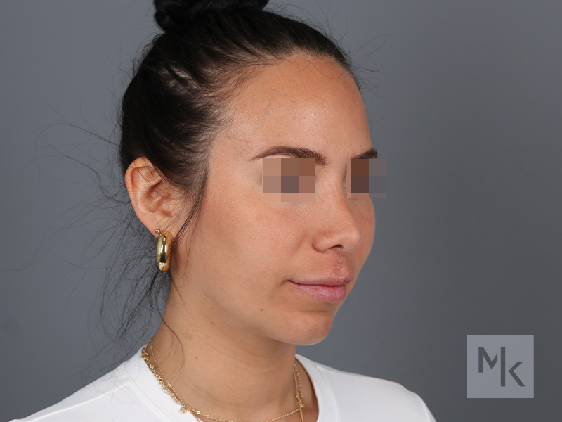 Rhinoplasty Revision Before and After | Dr. Michael Kim