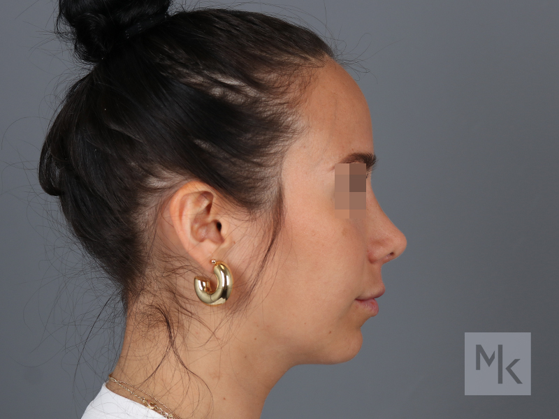 Rhinoplasty Revision Before and After | Dr. Michael Kim