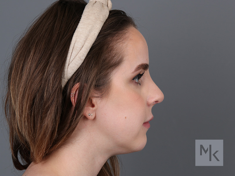 Rhinoplasty Revision Before and After | Dr. Michael Kim