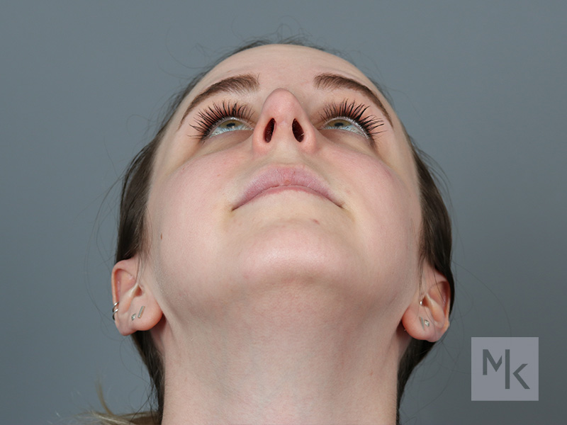 Rhinoplasty Revision Before and After | Dr. Michael Kim