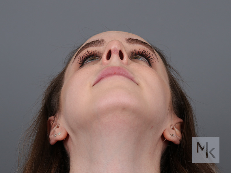 Rhinoplasty Revision Before and After | Dr. Michael Kim