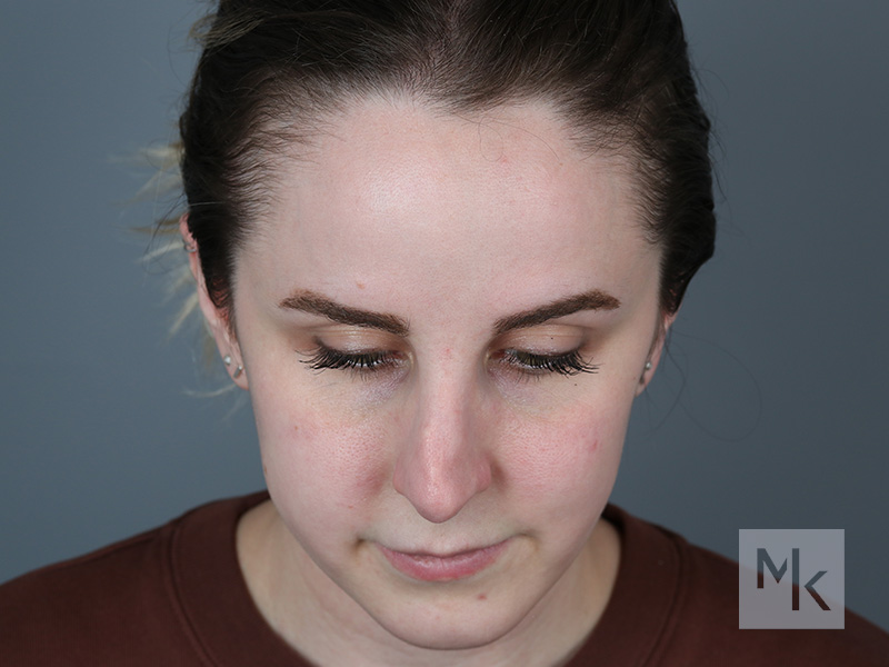 Rhinoplasty Revision Before and After | Dr. Michael Kim