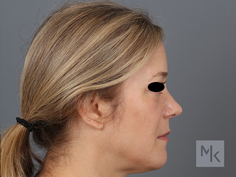 Rhinoplasty Revision Before and After | Dr. Michael Kim