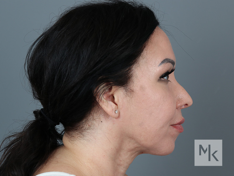 Rhinoplasty Revision Before and After | Dr. Michael Kim