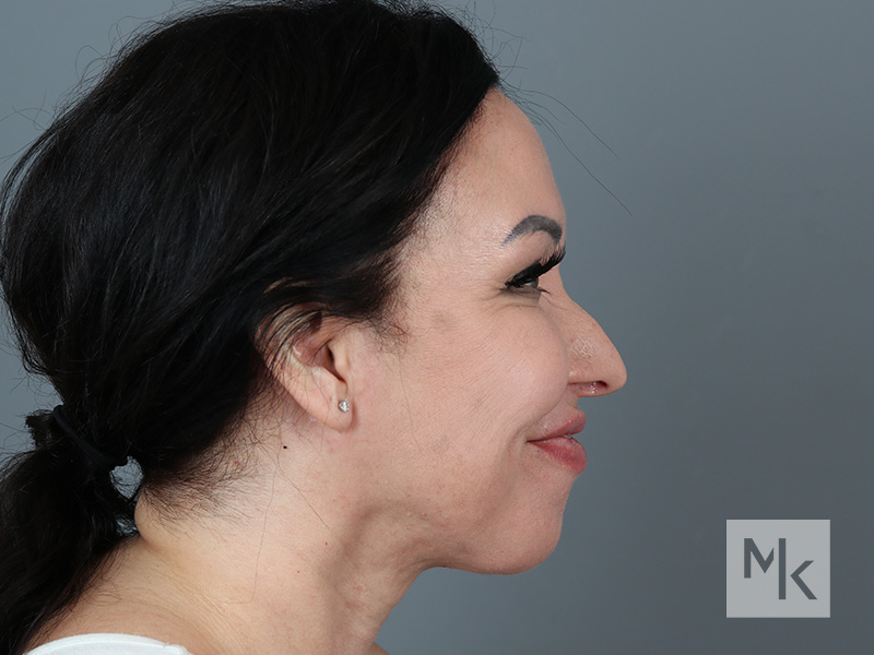 Rhinoplasty Revision Before and After | Dr. Michael Kim