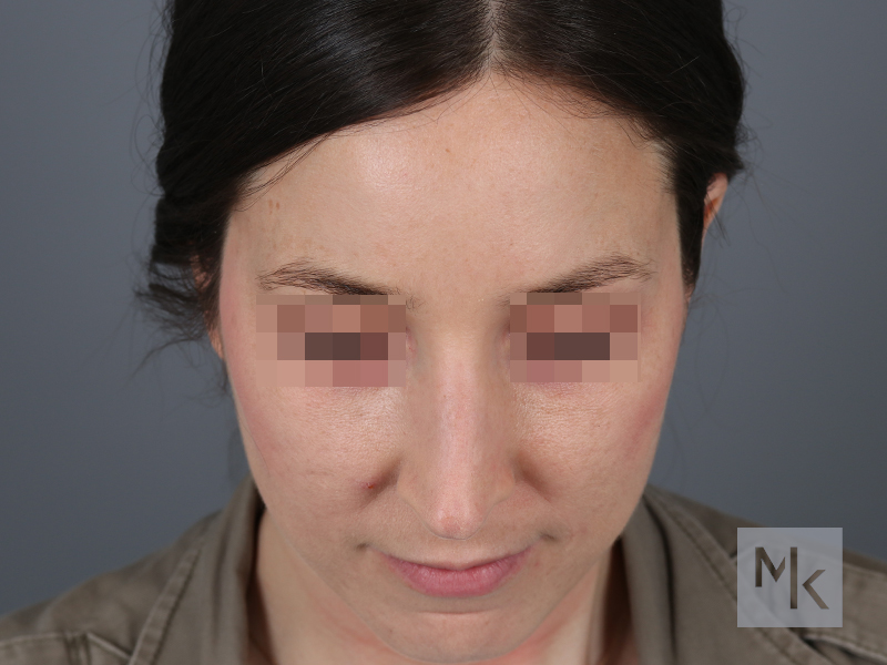 Rhinoplasty Revision Before and After | Dr. Michael Kim