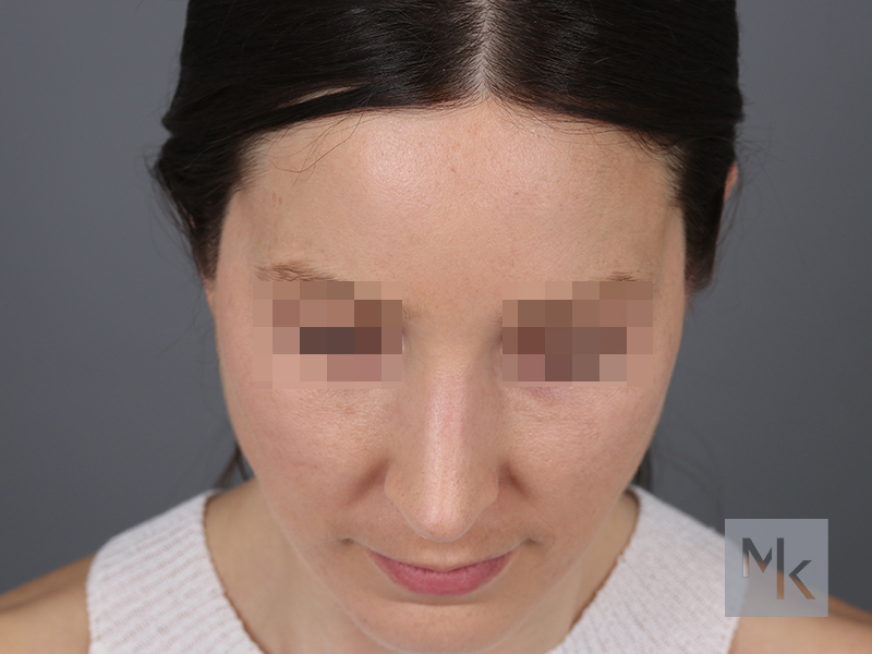 Rhinoplasty Revision Before and After | Dr. Michael Kim