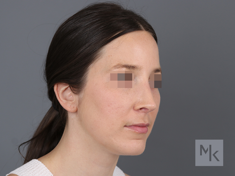 Rhinoplasty Revision Before and After | Dr. Michael Kim