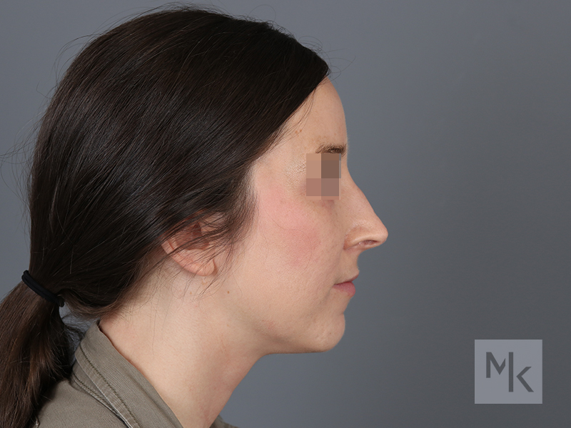 Rhinoplasty Revision Before and After | Dr. Michael Kim