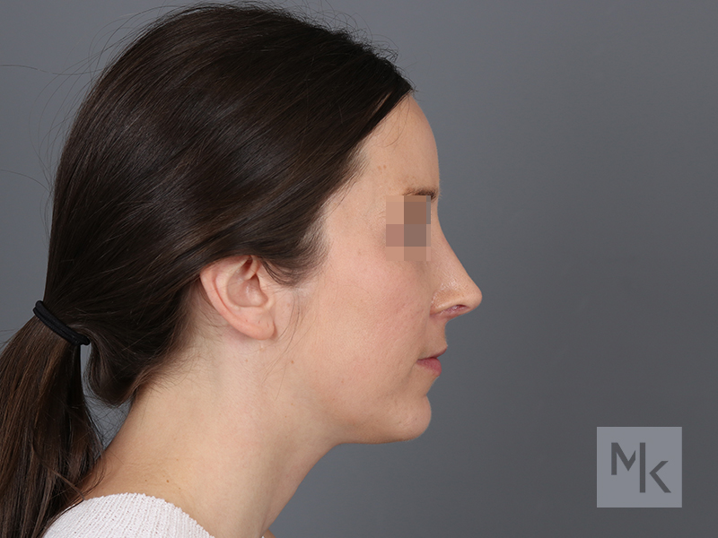 Rhinoplasty Revision Before and After | Dr. Michael Kim