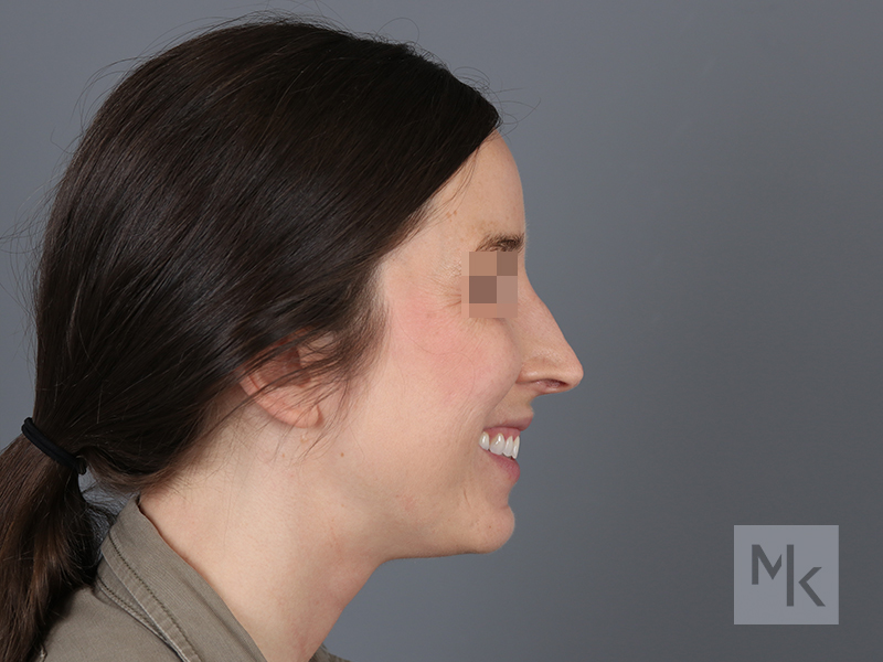 Rhinoplasty Revision Before and After | Dr. Michael Kim