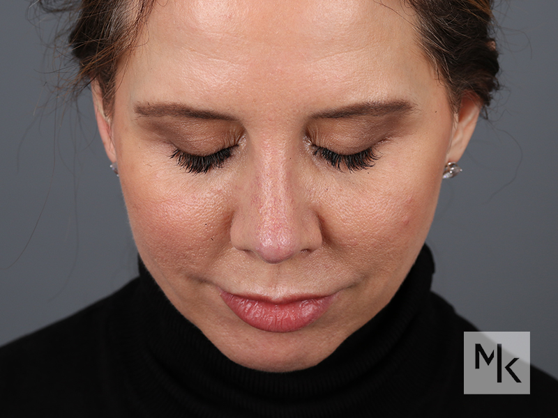 Rhinoplasty Revision Before and After | Dr. Michael Kim