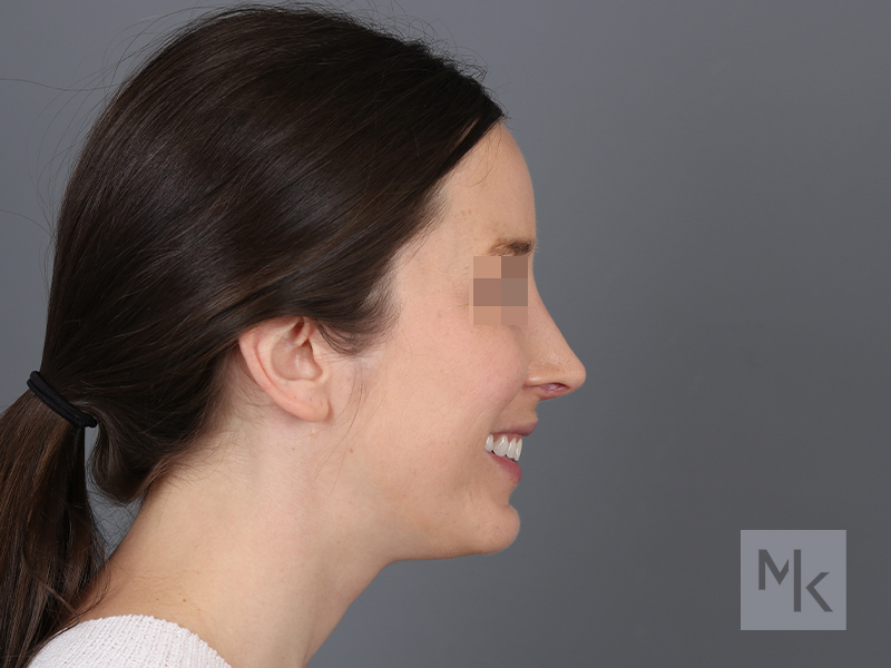 Rhinoplasty Revision Before and After | Dr. Michael Kim