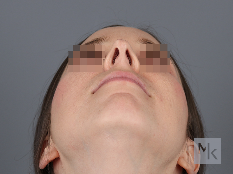 Rhinoplasty Revision Before and After | Dr. Michael Kim