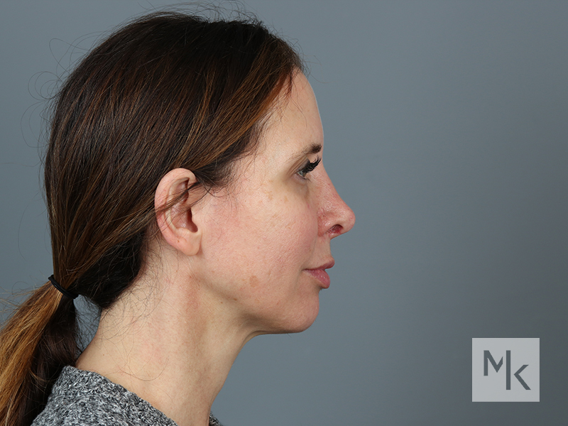 Rhinoplasty Revision Before and After | Dr. Michael Kim