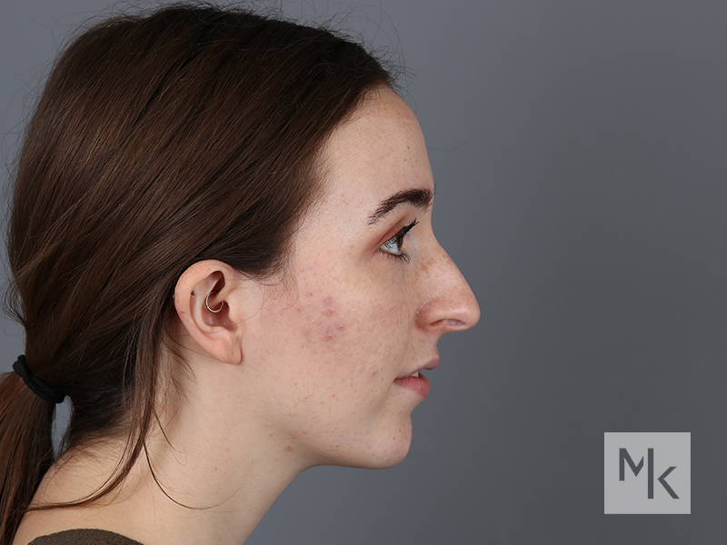 Rhinoplasty Revision Before and After | Dr. Michael Kim