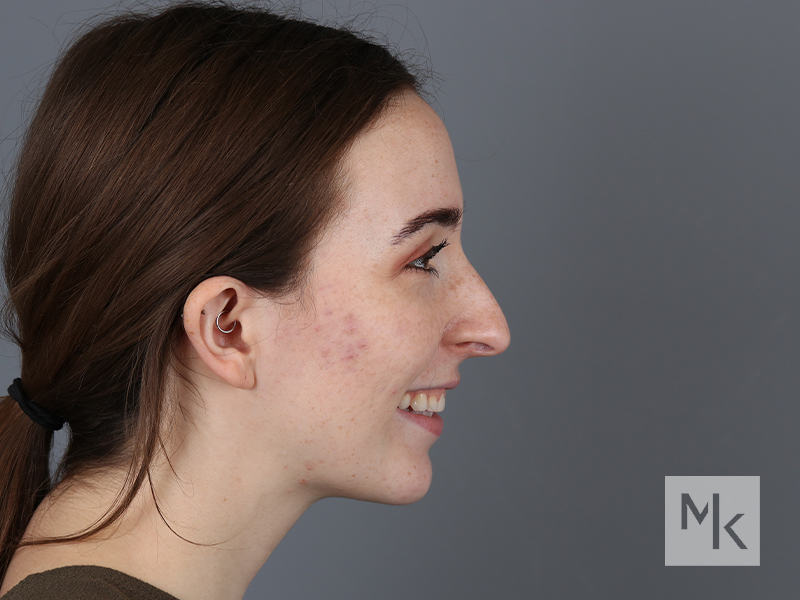 Rhinoplasty Revision Before and After | Dr. Michael Kim