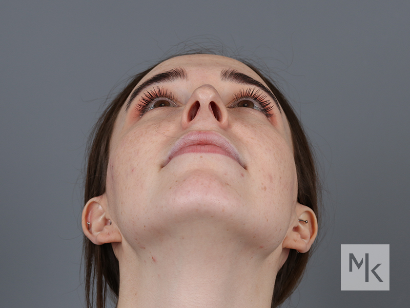 Rhinoplasty Revision Before and After | Dr. Michael Kim