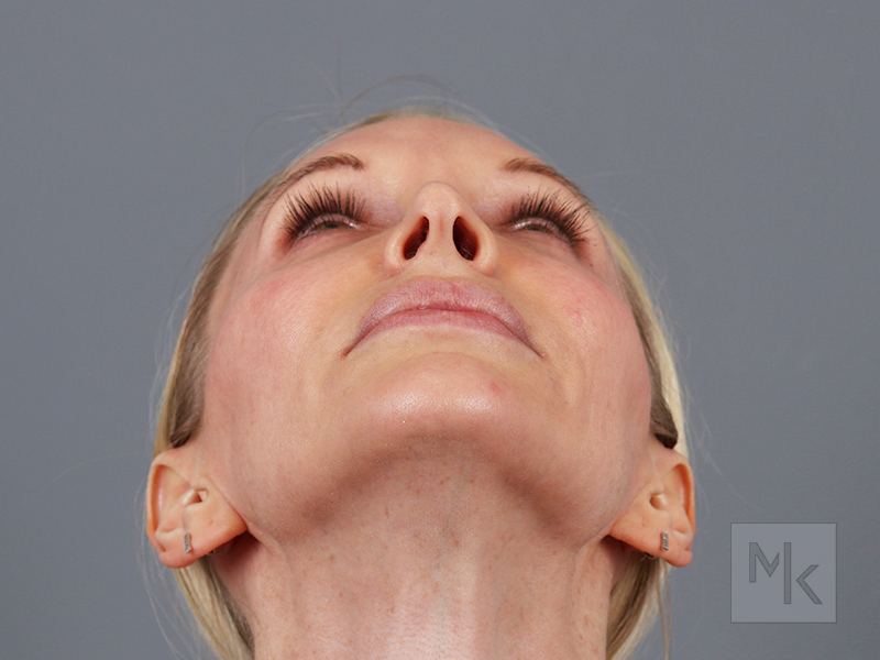 Rhinoplasty Revision Before and After | Dr. Michael Kim