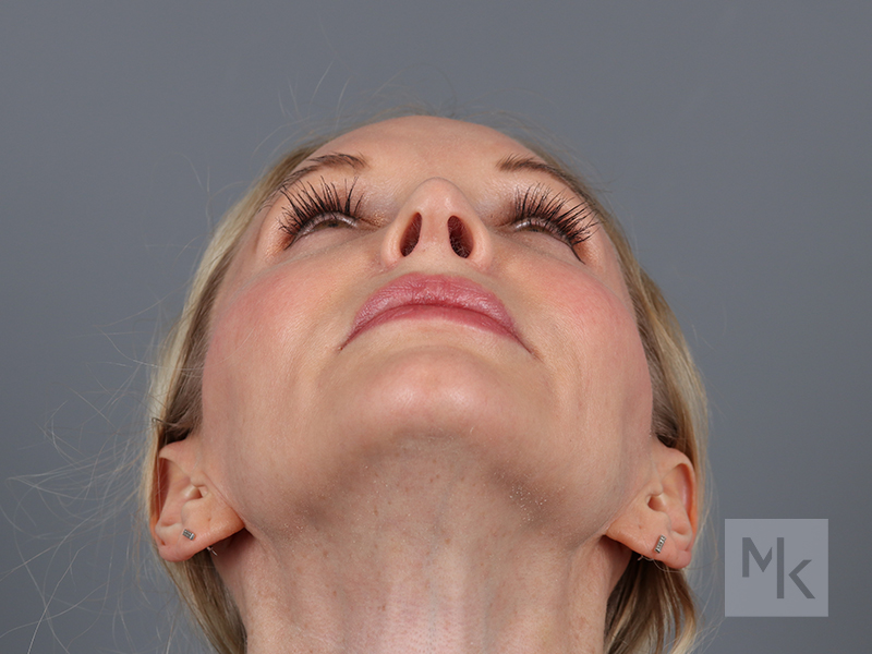 Rhinoplasty Revision Before and After | Dr. Michael Kim