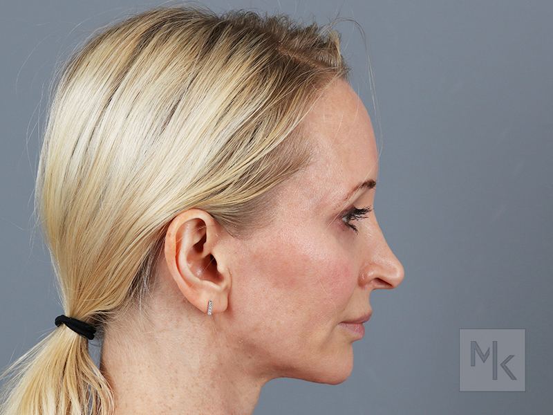Rhinoplasty Revision Before and After | Dr. Michael Kim
