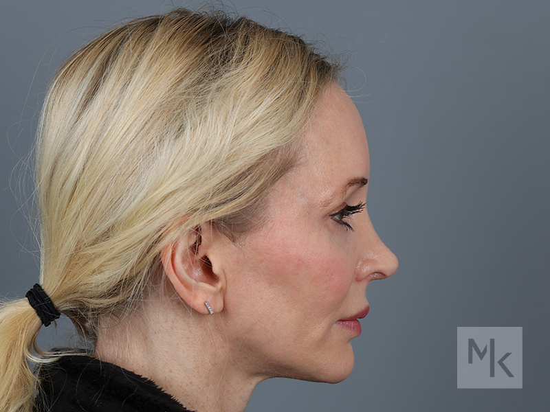 Rhinoplasty Revision Before and After | Dr. Michael Kim