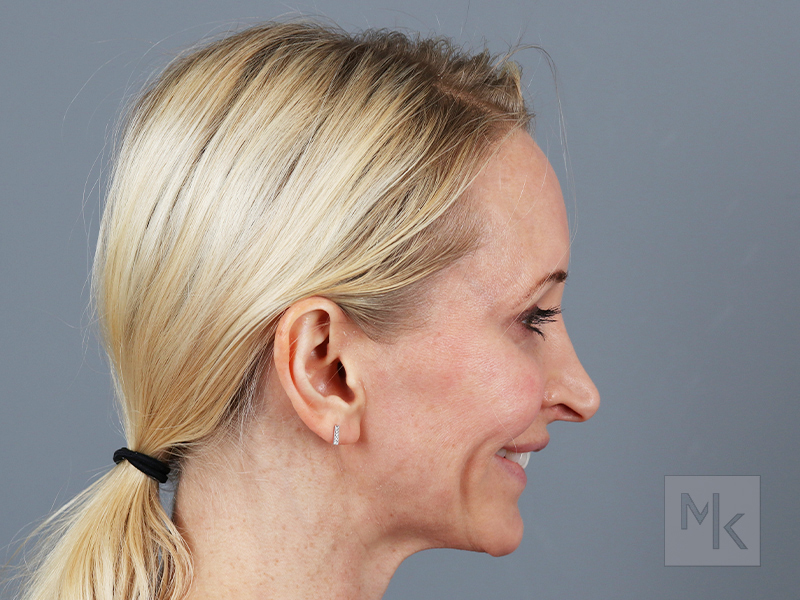 Rhinoplasty Revision Before and After | Dr. Michael Kim