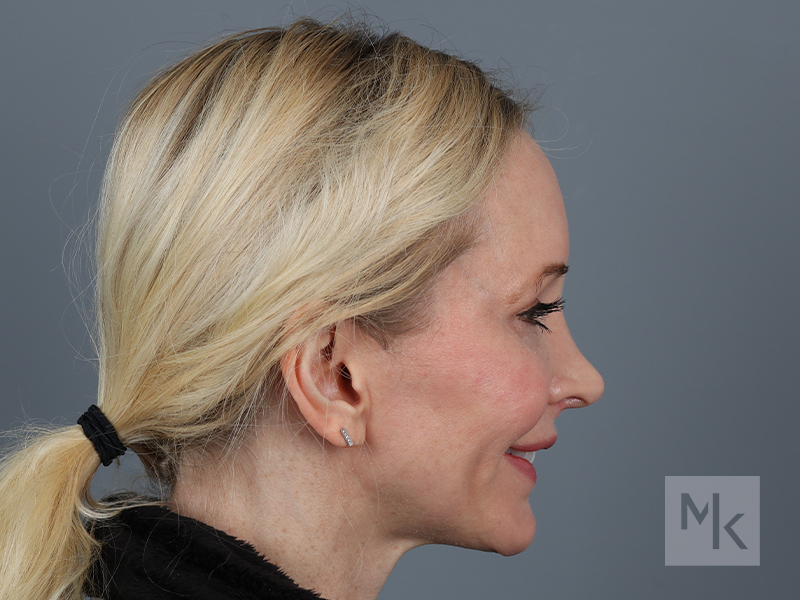 Rhinoplasty Revision Before and After | Dr. Michael Kim