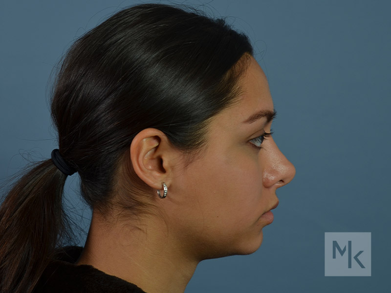Rhinoplasty Revision Before and After | Dr. Michael Kim