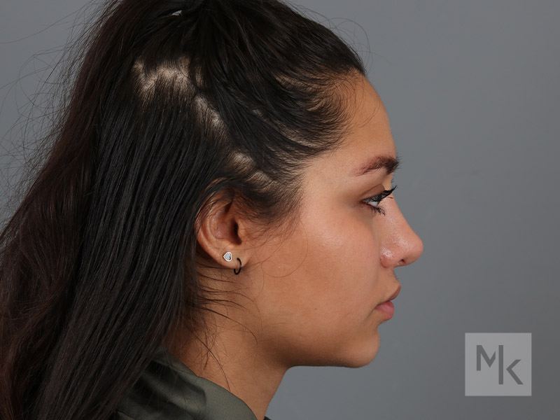 Rhinoplasty Revision Before and After | Dr. Michael Kim