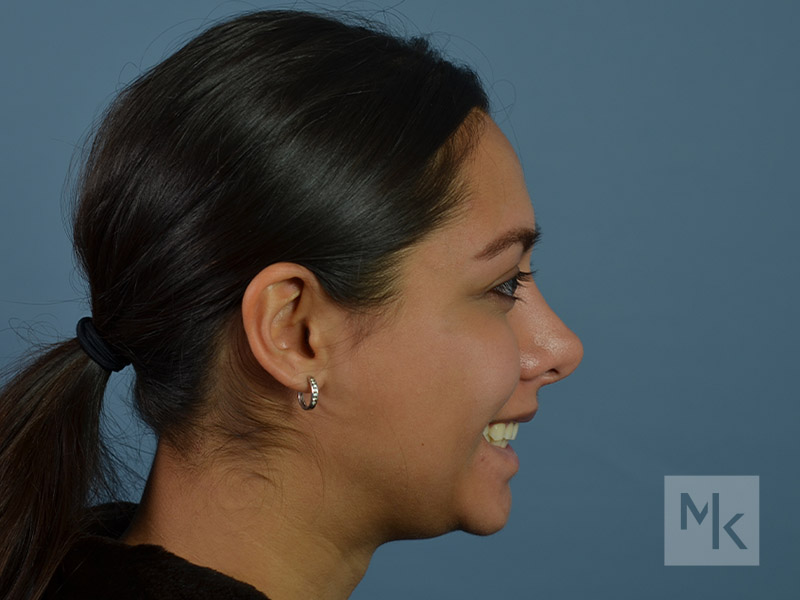 Rhinoplasty Revision Before and After | Dr. Michael Kim