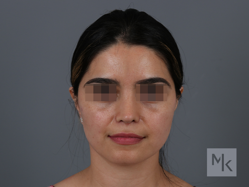 Rhinoplasty Revision Before and After | Dr. Michael Kim