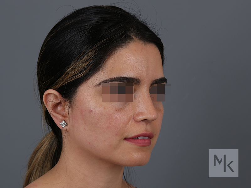 Rhinoplasty Revision Before and After | Dr. Michael Kim