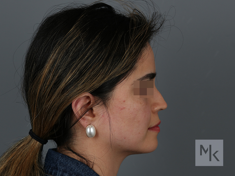 Rhinoplasty Revision Before and After | Dr. Michael Kim