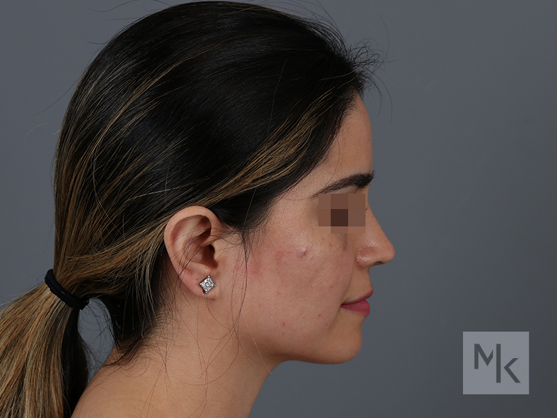 Rhinoplasty Revision Before and After | Dr. Michael Kim